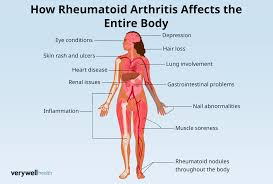 Rheumatoid